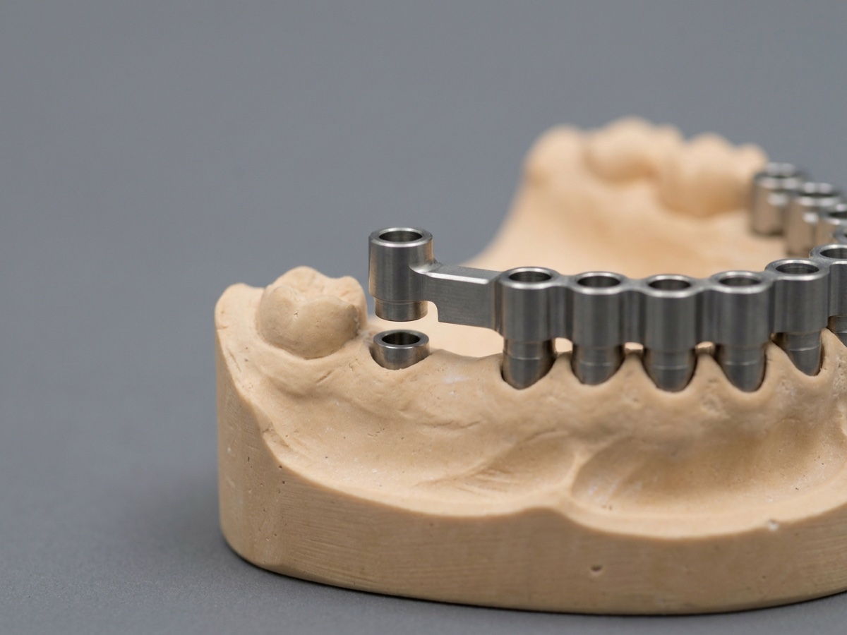 Implant bar on a model with one terminal cylinder standing off its analogue